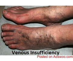 Venous Insufficiency in Snellville, GA 30078