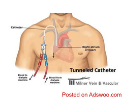 Tunneled Catheter Guidelines for Central Venous