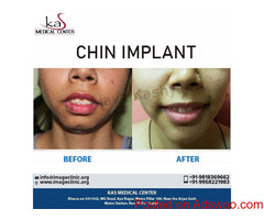 Chin Implant Surgery India Low Cost Benefits - Dr. Kashyap Clinic Delhi