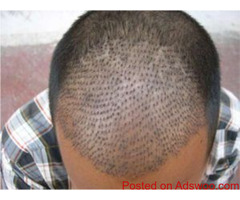 Hair Transplant Treatment Clinic in Delhi