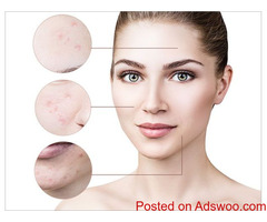 Best Acne Scars Treatment in Marathahalli, Bangalore