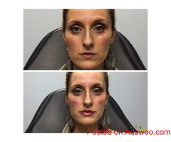 botox treatment louisville ky Call Us: (502) 974 3447