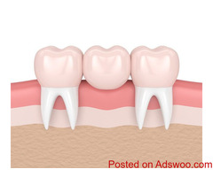 Get the Affordable Solution for Your Crooked teeth-Bayswater Dentist Crown & Bridges