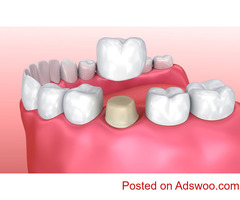 Get the Affordable Solution for Your Crooked teeth-Bayswater Dentist Crown & Bridges