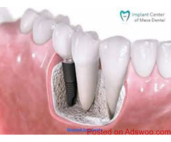 Dental Implants San Diego Cost - Implant Center of Mesa Dental
