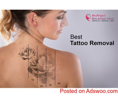 Best Tattoo Removal Laser Treatments in Bangalore