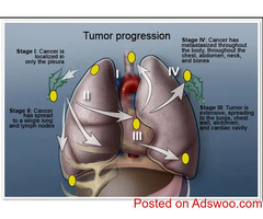 MESOTHELIOMA, Causes, Signs and Symptoms, Diagnosis and Treatment.