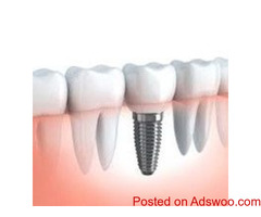 Implantes Dentales Accesibles -  Dr. Samuel Oliva Ovalle