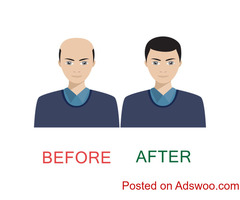 Hair Loss Treatment in Bangalore
