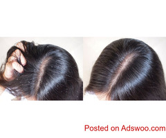 Hair Dandruff Treatment