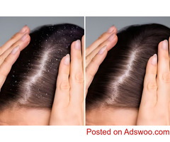 Hair Dandruff Treatment