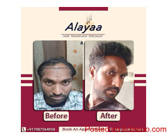 Hair Transplant Specialist, ?Hair Transplant Cost