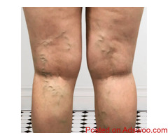 Chronic Venous Insufficiency: Find Relief with Leg Vein Rescue