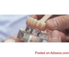 Root Canal Treatment in Koregaon Park, Pune