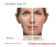 Coolsculpting In Alameda County