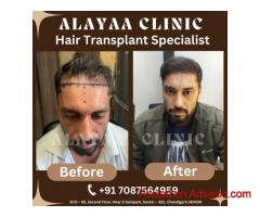 Transform Your Look The Best Hair Transplant Clinic in Chandigarh for Natural Results