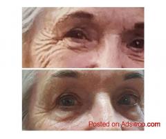 Face lifting in Upper Mount Gravatt