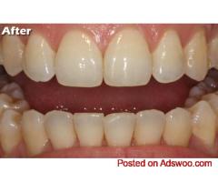 Protect Your Smile from Tooth Decay   Clarity Dental