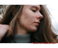 Clear Skin with Acne Treatment | The Look Medical Aesthetics
