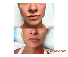 Refine Your Natural Beauty with Botox Near Me at The Look Medical Aesthetics