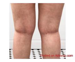 Leg Vein Health Support with Leg Vein Rescue for Strong Legs