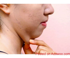 Double chin removal in Delhi