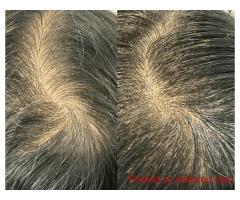 Hairline Restoration with Scalp Micropigmentation Vancouver