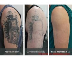 Safe & Effective Tattoo Removal in Calabasas for Clear, Renewed Skin