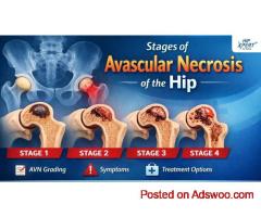 Stages of Avascular Necrosis Hip – Symptoms & Treatment