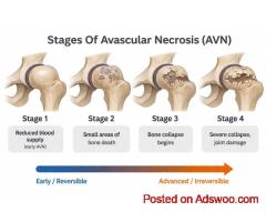 Stages of Avascular Necrosis Hip – Symptoms & Treatment