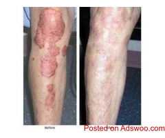AROGYAM PURE HERBS KIT FOR PSORIASIS