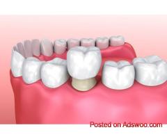 Cosmetic Dental Crowns & Veneers in Perris - Dr. Tejas Modi