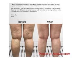 Varicose Veins Treatment for Healthy Legs | Leg Vein Rescue