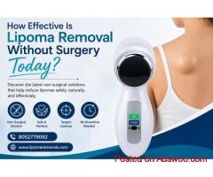 How Effective Is Lipoma Removal Without Surgery Today?