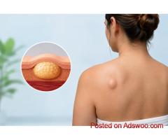 Lipoma Removal Natural: Questions People Ask Most Often